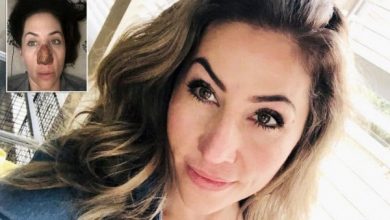 كيف أصبح وجه فتاة حسناء بعد عملية تجميل فاشلة؟
