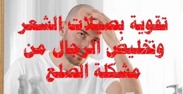 أسهل وسيلة "رخيصة" للتخلّص من الصلع