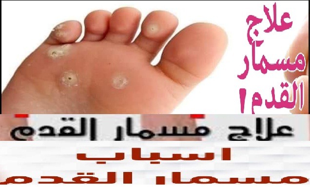 علاج مسمار القدم و عين السمكه بالأعشاب .