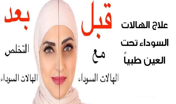 علاج الهالات السوداء حول العين