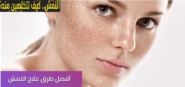 أفضل طرق علاج النمش