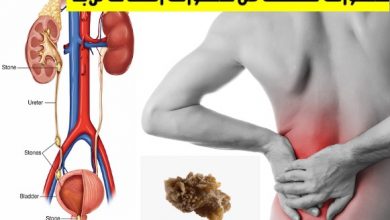 حصوات في الكلى | أعراض وأسباب وطرق العلاج في المنزل