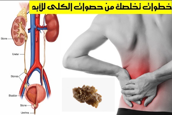 حصوات في الكلى | أعراض وأسباب وطرق العلاج في المنزل