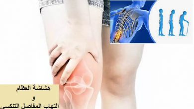 هشاشة العظام  Osteoporosis