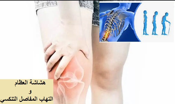 هشاشة العظام  Osteoporosis