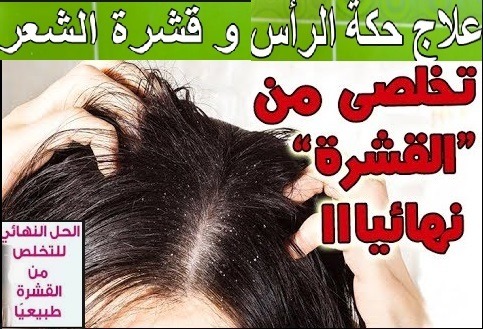 استخدام الأعشاب للتخلص من قشرة الشعر