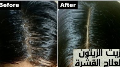 زيت الزيتون لعلاج قشرة الرأس